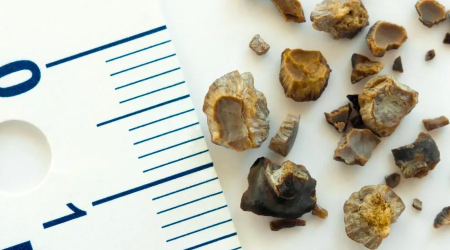Oxalate and Kidney Stones