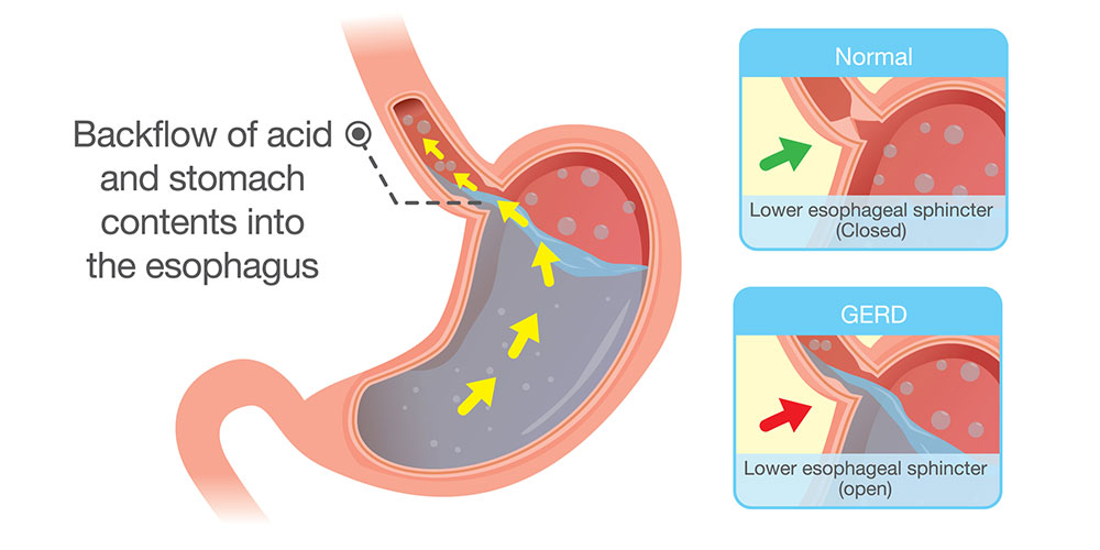 acid reflux diagram